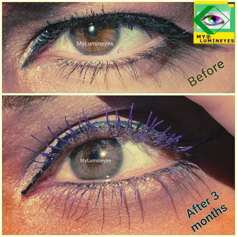 Eye Color Laser Surgery Cost And Guide