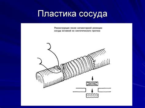 Операции на сосудах - презентация онлайн