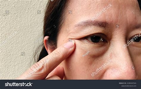 110 Sagging Eyelids Filler Images, Stock Photos & Vectors | Shutterstock