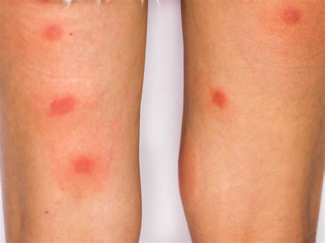 how long do bed bug bites take to go away