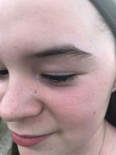 Pilomatricoma--One Family's Story