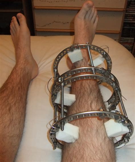 What Is A Internal Fixation Device at Michael Doxey blog