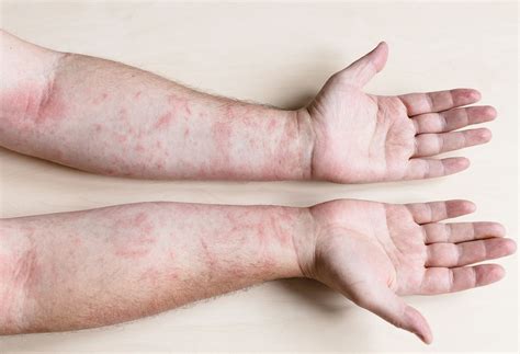 Can Celiac Disease Cause Rashes? | The Well by Northwell