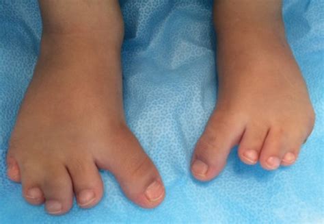 feet   homozygous child  note   long