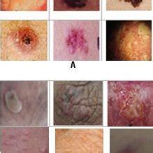 The skin library samples, (A) Samples with Skin diseases (B) Samples ...