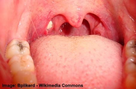 Causes of White Spots on Throat Based on Science (Images Included)
