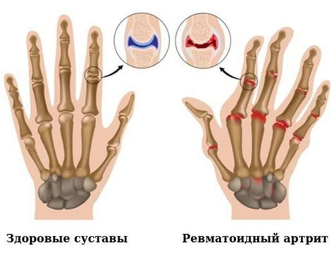 Ревматоїдний артрит: симптоми, діагностика та лікування в Києві