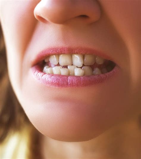 crowded teeth square mile dental centre dental care london