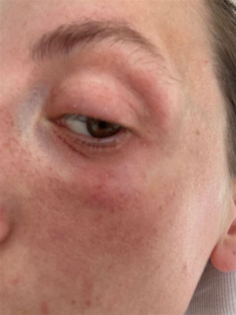 Eye Contact Dermatitis - Beauty Insider Community