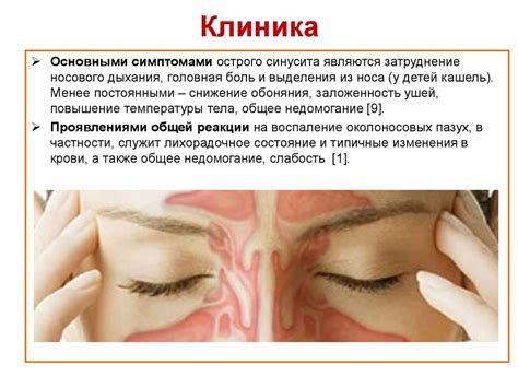 Острые синуситы - презентация онлайн