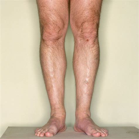 benign fasciculation syndrome neat