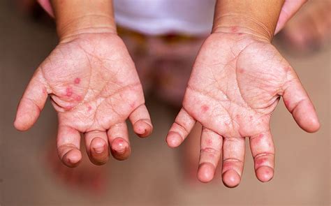 Hand Foot Mouth Disease (HFMD) What to Do