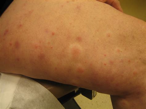 Leukocytoclastic vasculitis inflammation - Cancer Therapy Advisor