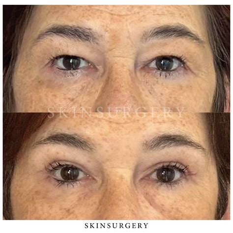 Upper Eyelid Surgery | #1 in Eyelid Surgery | SkinSurgery Clinics