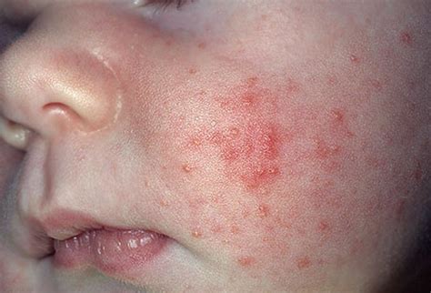 baby rashes on face - pictures, photos