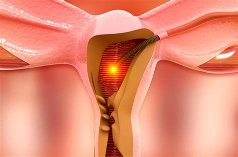 dilation  curettage dc doral health wellness ny