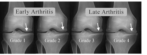 Knee Arthritis Treatment | DR. RAJ KANNA Knee clinic, Chennai