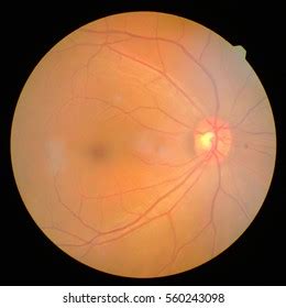 retinal stock photo  shutterstock
