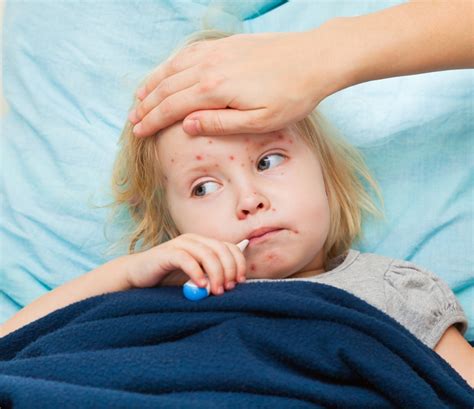 Morbili: Simptomi, komplikacije i prevencija. Historija i značaj ...