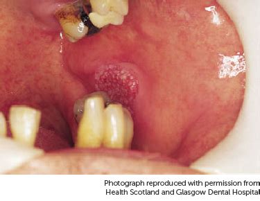 Pictures Of Mouth Cancer | Cancer Research UK