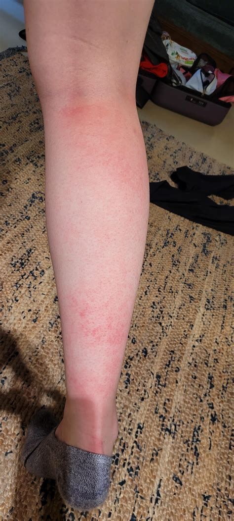 Sudden Skin Rash on vacation in Italy : r/DermatologyQuestions