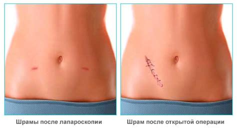 Шрам от аппендицита: фото и лечение