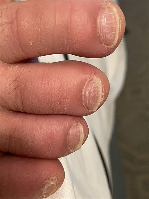 nail fungus picture rnailfungus
