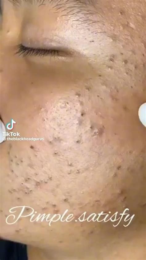 This Unbelievable Blackhead Removal 2024 Trick Changed My Life! - jen4x52