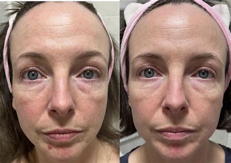 232 best Azelaic Acid images on Pholder | Skincare Addiction, Tretinoin ...