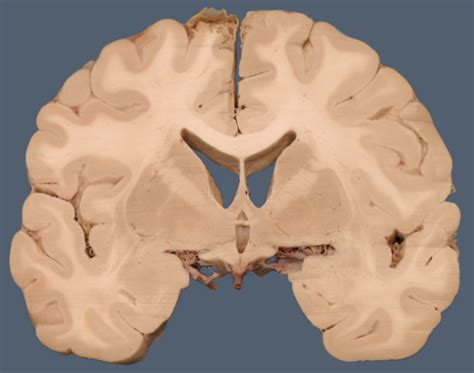 brain slice coronal quiz diagram quizlet
