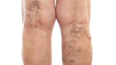 Overview: Minimally Invasive Treatments for Bothersome Leg Veins | Central Coast Vein & Vascular