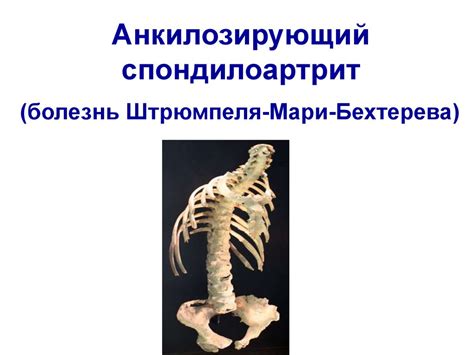 Серонегативные спондилоартриты - презентация онлайн