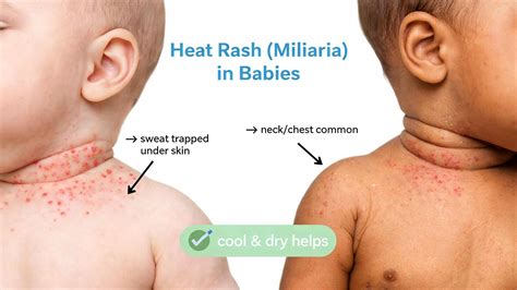 baby rash types  pictures  doctors guide