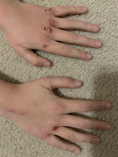 how to fix dry knuckles