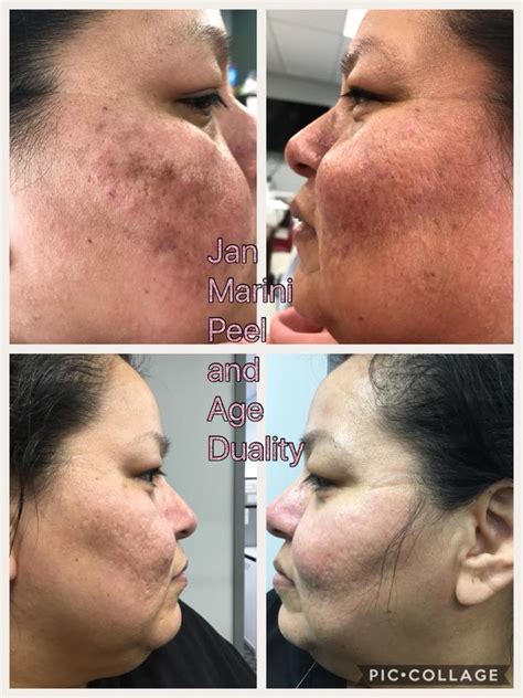 chemical peel     drxkt