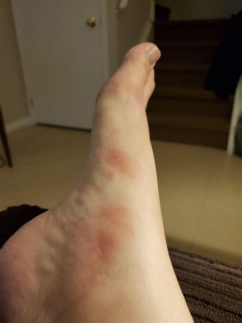 I have an itchy bug bite on my leg. It’s not going away and is formed a
