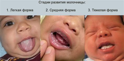 Thrush in newborn babies and infants in the mouth on the tongue ...