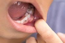 Pus - Definition of Pus