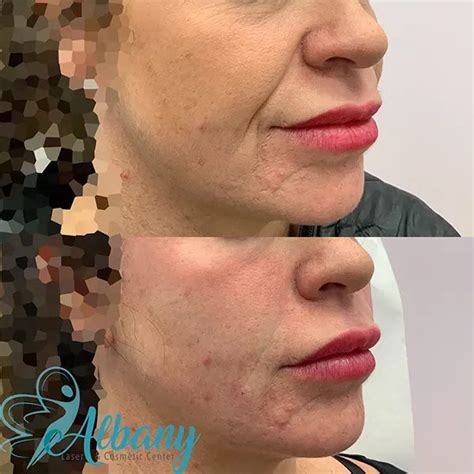 Edmonton Dermal Fillers and Anit Aging Clinic | Albany Laser