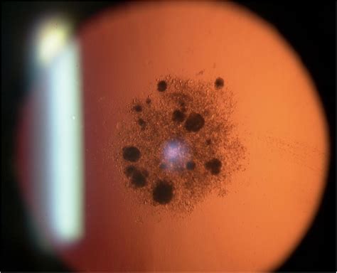 christmas tree cataract 5