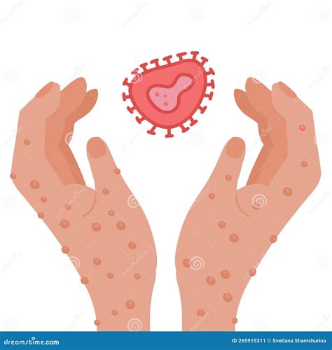 Hands with Monkeypox Rash Holding Virus Cell. New Virus Outbreak