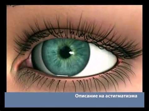 Астигматизъм - причини, симптоми, лечение