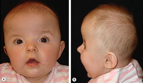 Mild Hypertelorism Causes