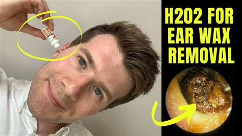 How To Remove Ear Wax With Home Remedies at Theodore Crawford blog
