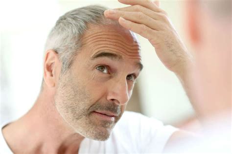 Hair Thinning in Front - Male & Female Baldness Treatment | Advanced ...