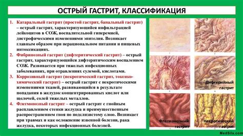 Острый и хронический гастрит - симптомы и особенности.
