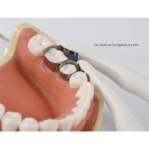 Dental Band For Matrix at Robert Connors blog