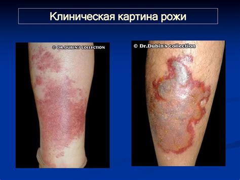 Рожа. Клиника, диагностика и лечение - презентация онлайн