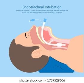 Esophageal Tracheal Tube Vs Endotracheal Tube