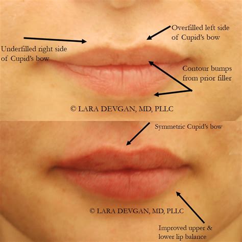 Do Lips Get Lumpy After Fillers | Lipstutorial.org